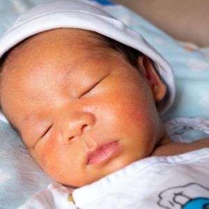 Yellow Skin Colored Neonatal Jaundice Happen In New Born Baby Infant T20 Jorvok 1.jpg